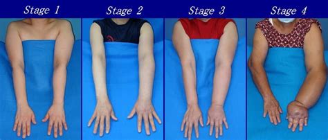 Lymphedema Condition Overview Causes Stages Symptoms Treatments