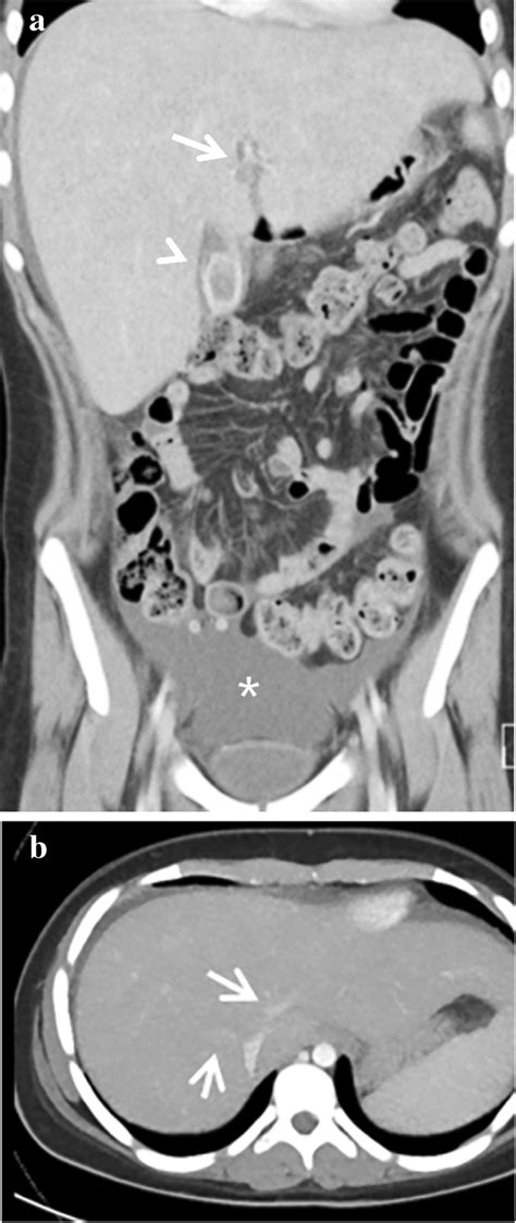 Computed Tomography Ct Features Of Sinusoidal Obstruction Syndrome A