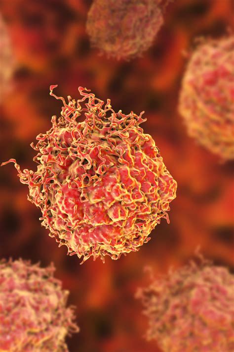 Tumor Cell Type Identified That Makes Prostate Cancer More Aggressive