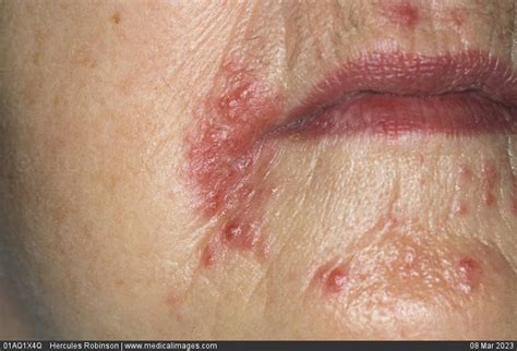 Stock Image Dermatology Perioral Dermatitis A Red Vesicular And