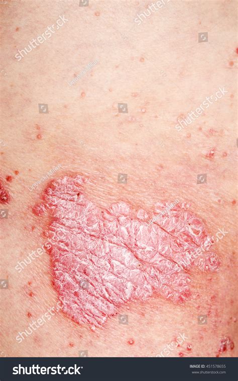 Detail Psoriasis Vulgaris Skin Disease Stock Photo 451578655 Shutterstock
