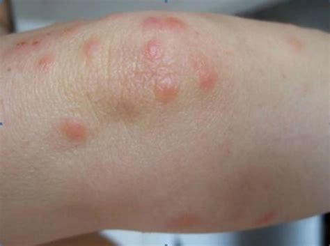 Top Close Up Pictures Of Bed Bug Bites Abdul Muqeet