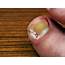 Ingrown Toenail Treatment At MD First Primary & Urgent Care