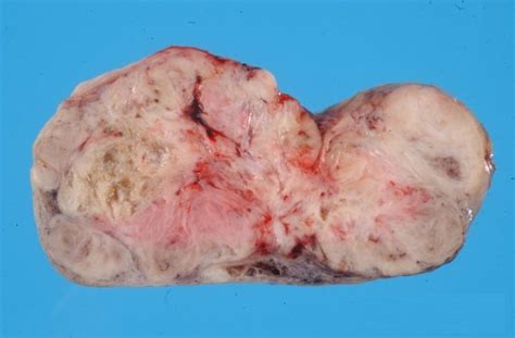 Medical Pictures Info Granulosa Cell Tumor
