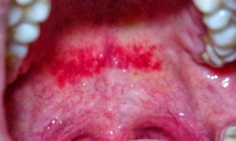 There is no known specific causal agent that leads to the outbreak of canker sore. Red Spots In Roof Of Mouth - Muscular Asian Porn