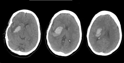 Ct Scan Of Head Showing Right Basal Ganglia Haemorrhage Following