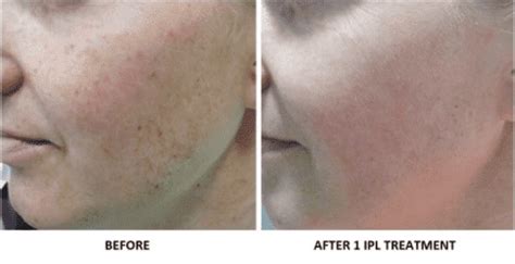 Photofacial Bismarck Nd Pure Skin Aesthetic And Laser Center