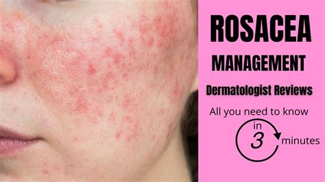 Rosacea The Fundamentals By Dr Davin Lim Dermatologist Youtube