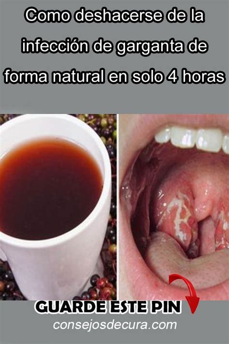 Pin De Martha Cardona En Salud Infeccion Garganta Formas Naturales Y