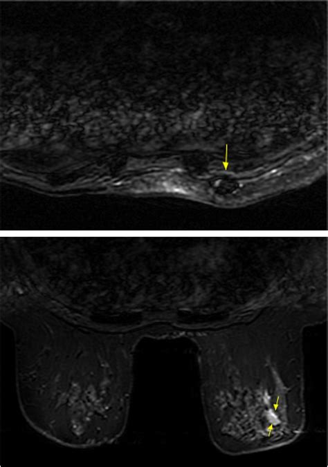 Imaging Features Of Breast Malignancy Breast Ultrasound And Mr Imaging