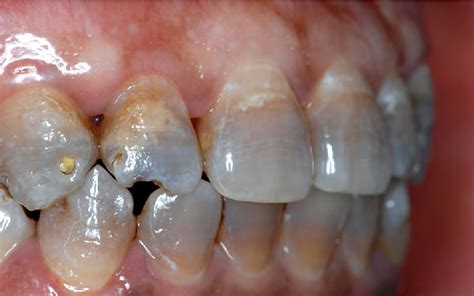 Oral Medicine Tooth Staining And Discoloration Directorio Odontológico