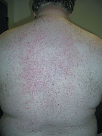 Itchy Rash On Back