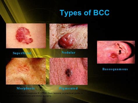 Carcinomas start in epithelial tissues, which cover organs and line various spaces in the body. Basal Cell Carcinoma - Dr. Novikov Wellness and Skin Care