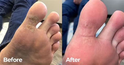 Swift Wart Removal Plantar Wart Removal Wart Treatment Knoxville Tn