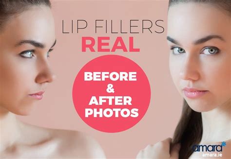 Lip Fillers Real Before And After Photos Amara Clinics