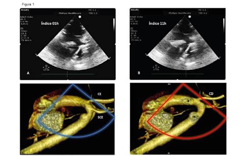 Role Of Transthoracic Echocardiography In The Diagnosis Of Double