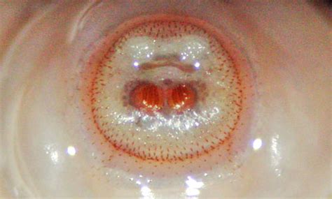 Botfly Larvae In Human Bilentusiaster