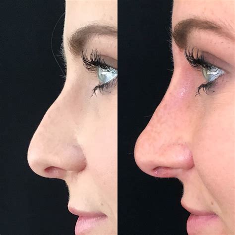 Pin By Jay Little On Nonsurgical Rhinoplasty Nose Surgery Lipo
