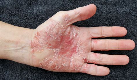 Skin Disorders And Infections Health Information