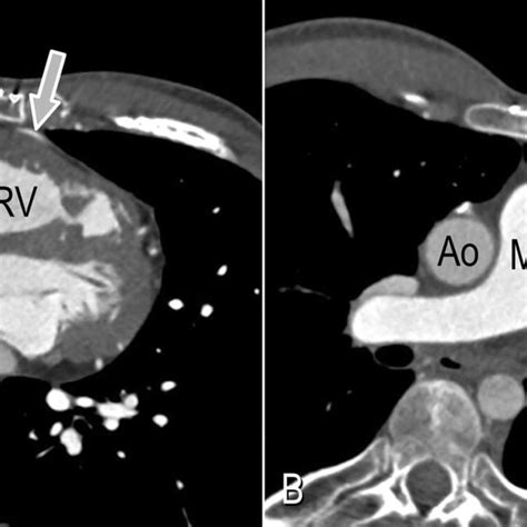 Axial Images Of Chest Ct Scan Without Intravenous Contrast A At The