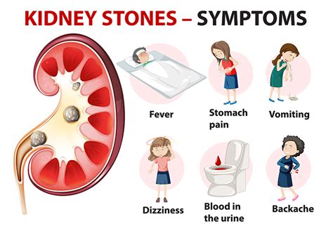 Common Signs Of Kidney Stones And Its Prevention Cfkc