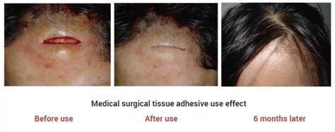 Pin On Medical Tissue Adhesive Surgical Glue