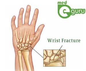 Similarly in computer networks a backbone network is as a network containing a high capacity connectivity infrastructure. What are Broken Wrist Treatments | Wrist Fracture ...