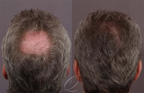 Male Crown Hair Restoration Before And After Photo Gallery Rochester