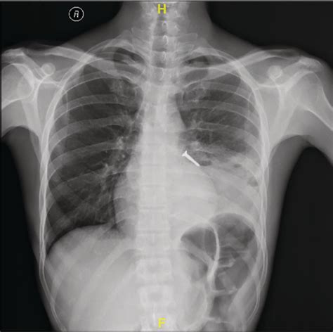 Chest X‐ray Posteroanterior View Showing Left Lower Lobe Consolidation