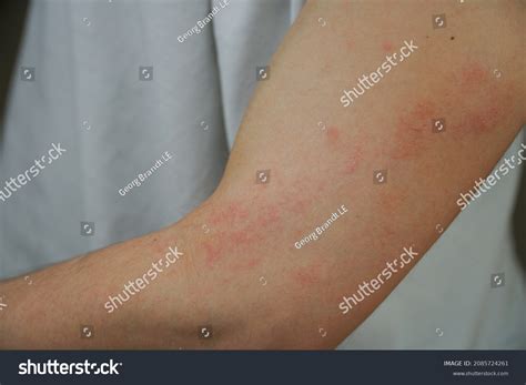 Itchy Skin Rash Elbow Stock Photo Edit Now 2085724261