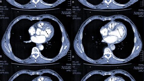 Heart Ct Scan Uses What To Expect Results And More