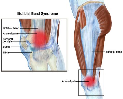 Iliotibial Band Syndrome Specialist In Augusta Ga Georgia Clinic Of