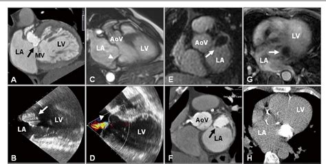 Figure 1 From Caseous Mitral Annular Calcification Along The