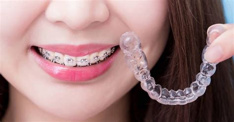 Whats Shortest Time Period For Braces How To Shorten It