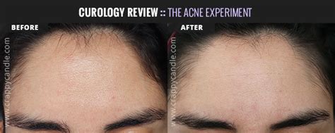Curology Review The Acne Experiment Crappy Candle