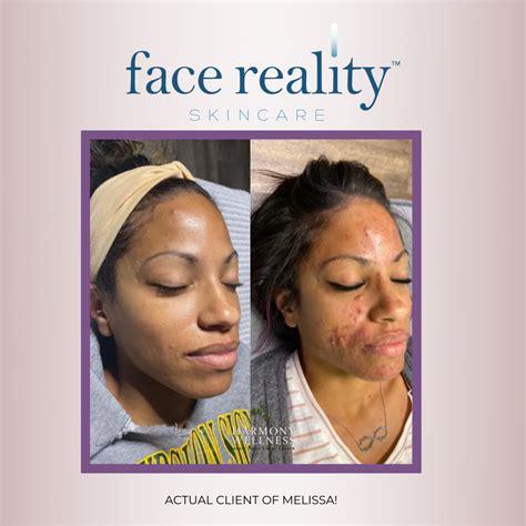 Put An End To Acne In 2022 With Face Reality Harmony Wellness