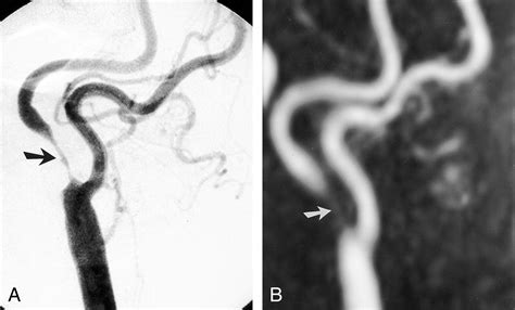 Contrast Enhanced 3d Mr Angiography Of The Carotid Artery Comparison