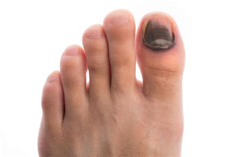 5 Common Mistakes Runners Make That Damage Their Toenails Arizona Foot