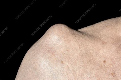 Sebaceous Cyst Stock Image C0506766 Science Photo Library