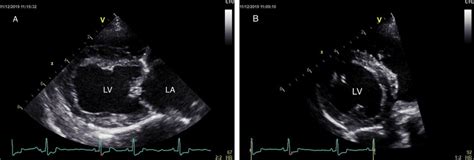 A Right Parasternal Long Axis View And B Right Parasternal