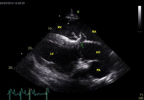 Echocardiographic Image Of The Aorto Cardiac Fistula Right Parasternal