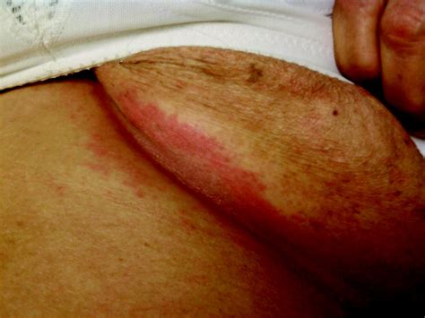 Symptoms of intertrigo the symptoms of intertrigo include red or red brown spots that rubbing the skin together or detecting wetness. Resistant "Candidal Intertrigo": Could Inverse Psoriasis ...