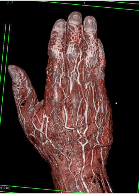 Cellulitis In The Hand With Vascular Mapping Musculoskeletal Case