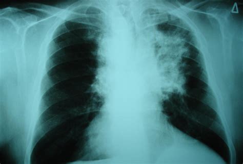 Leukemia Drugs Hold Promise For Treatment Resistant Lung Cancer