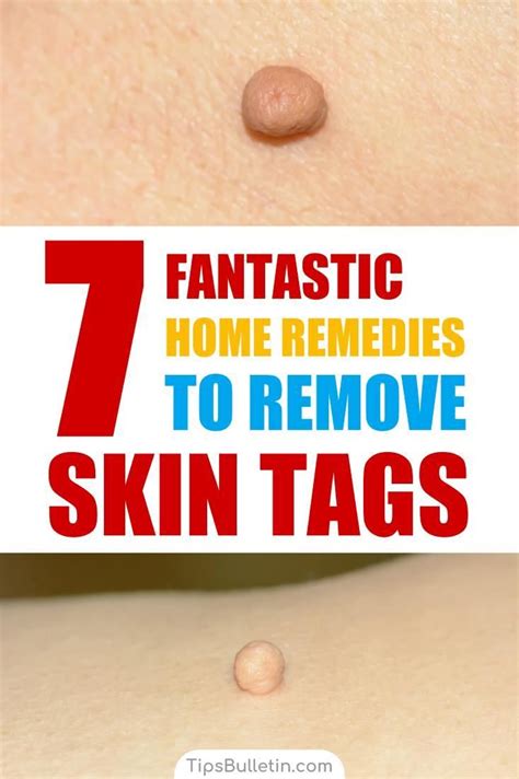 7 fantastic home remedies to remove skin tags skin tag removal skin tags on face skin tag
