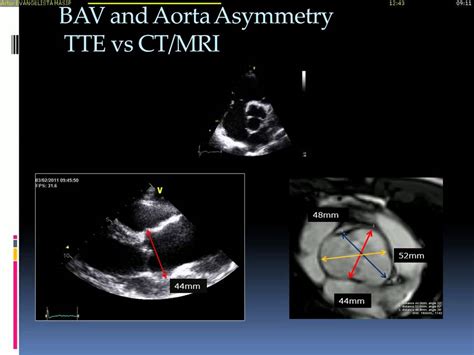 Echocardiographic Assessment Of Bicuspid Aortic Valve Youtube