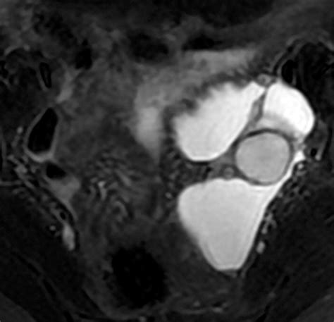 Hemorrhagic Ovarian Cyst Mri Sexiz Pix