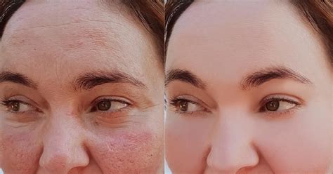 Favoured by dermatologists and facialists all over the globe, retinol's. Treating Rosacea: Vitamin K & Vitamin C - A WordPress Site