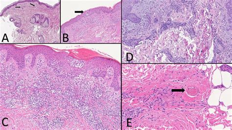 Histopathological Observations In Covid 19 A Systematic Review