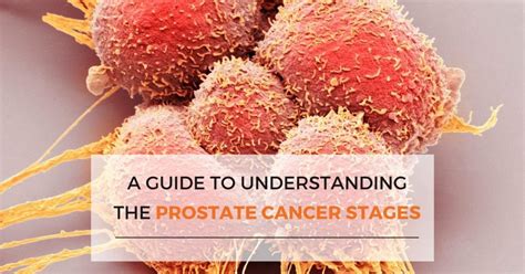 Prostate Cancer Understanding The Stages Sri Ramakrishna Hospital